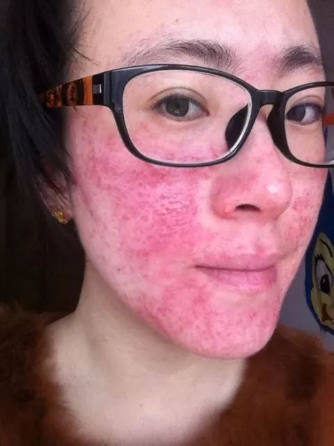 日一晒脸就痛用水洗完脸秒变"大红脸"换了n种护肤品皮肤依然很敏感好