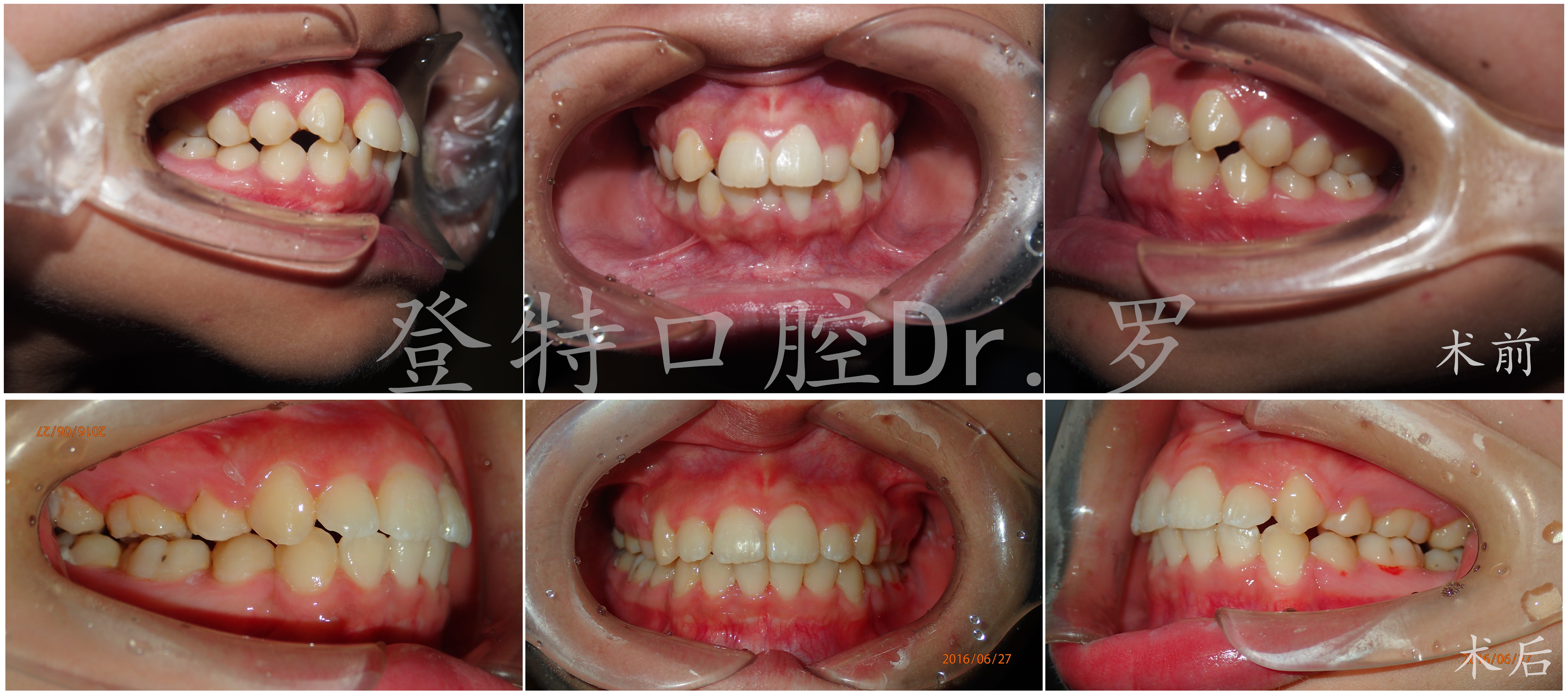 除此之外,又有哪些牙齿是有存在"问题",需要进行牙齿矫