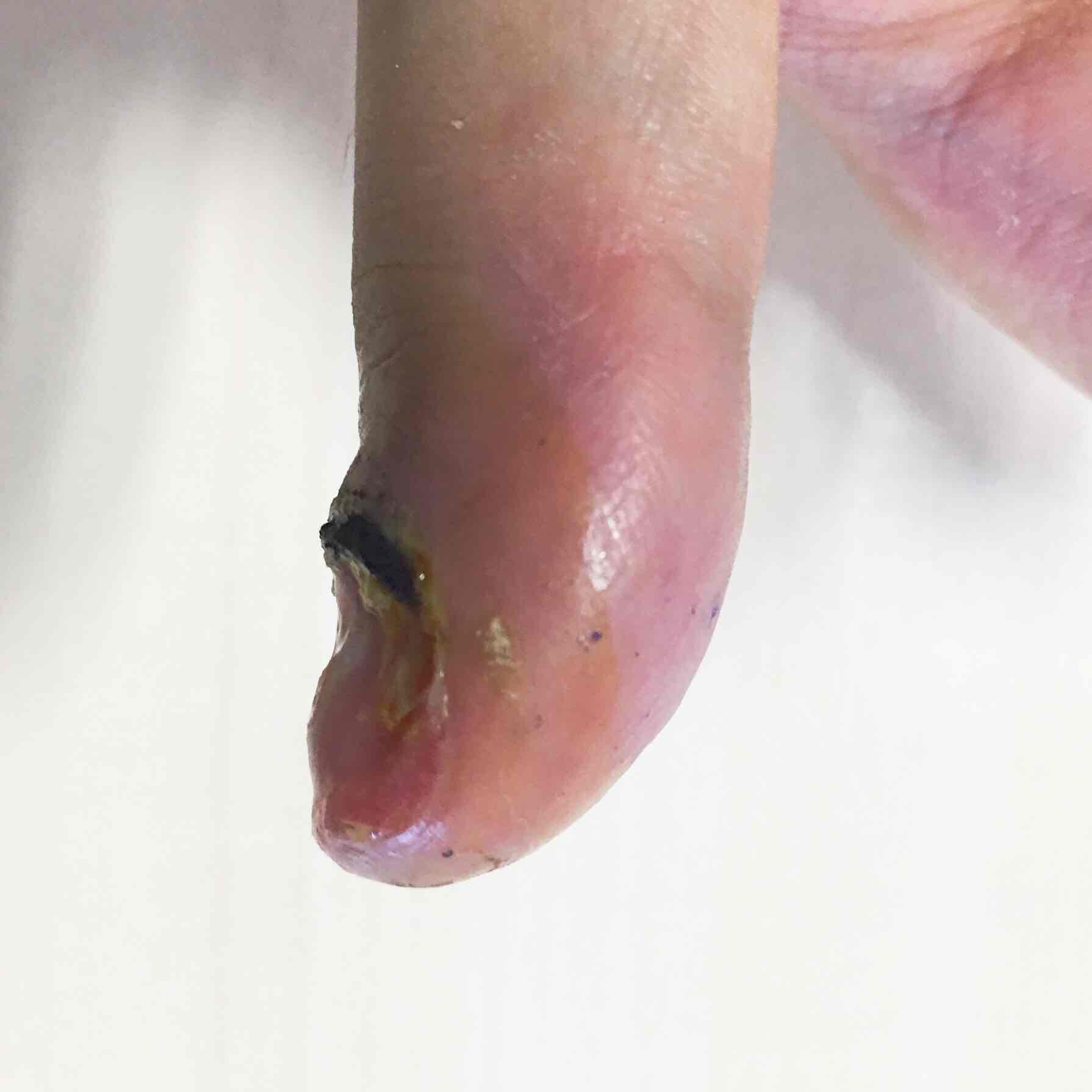 难以驱赶的真菌感染:真菌性指头炎