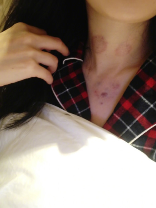 杨幂感冒十几天一度失声接受针灸放血治疗