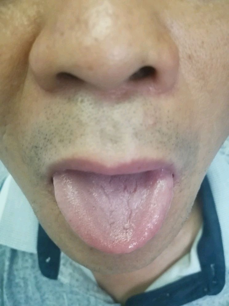 天生裂纹舌图片图片