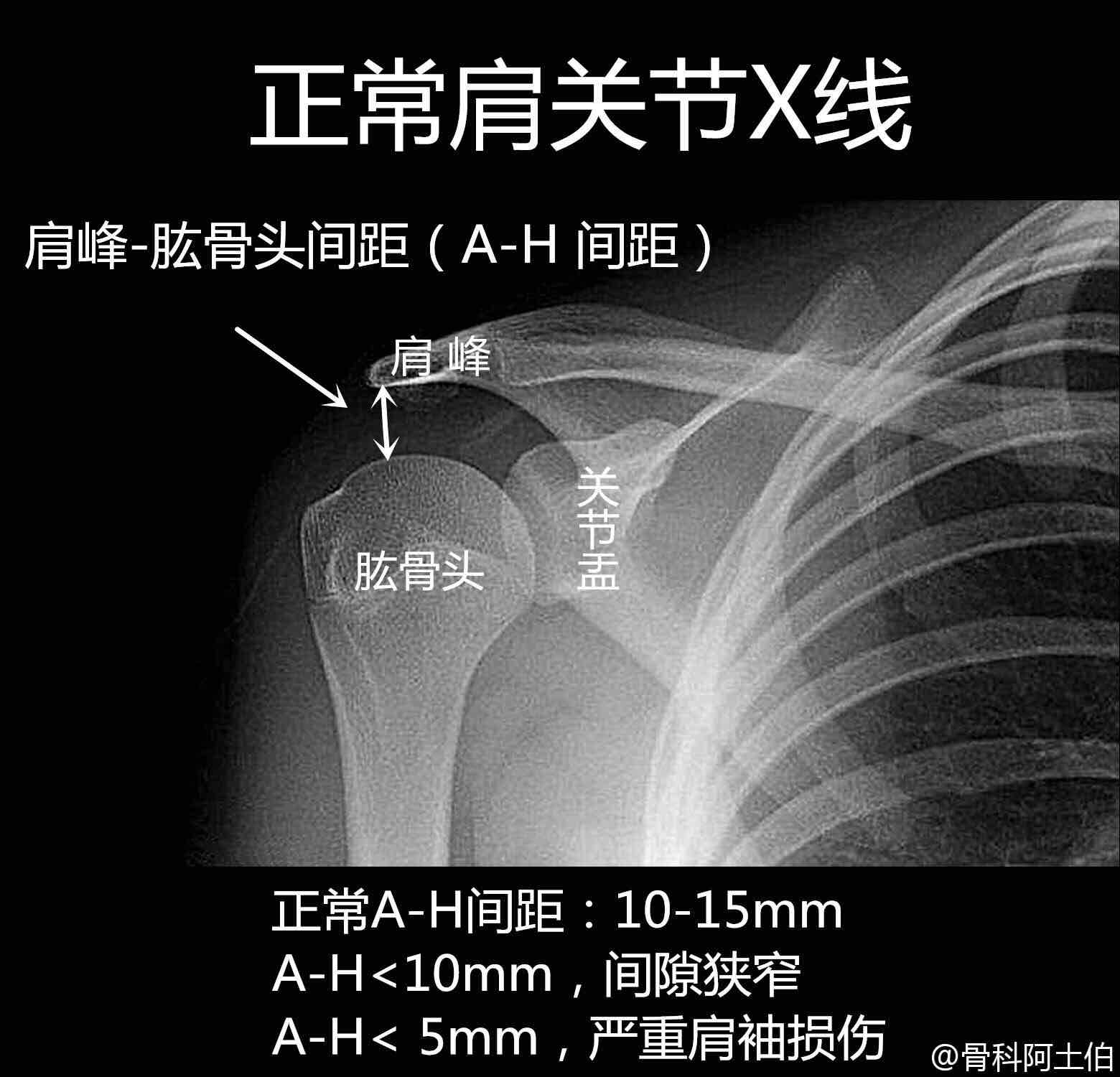 肩关节x光片正常图片