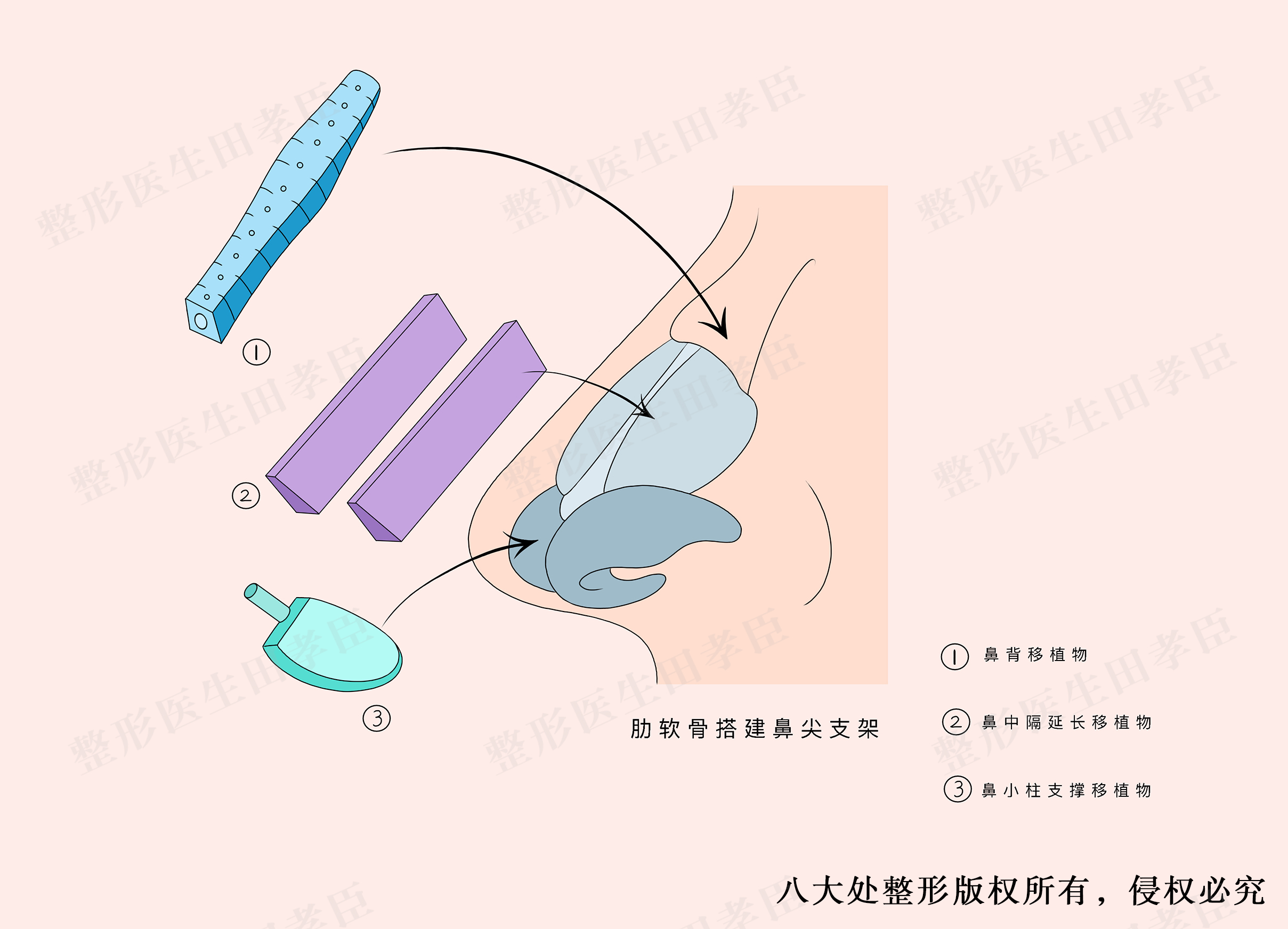 象鼻支架手术图图片