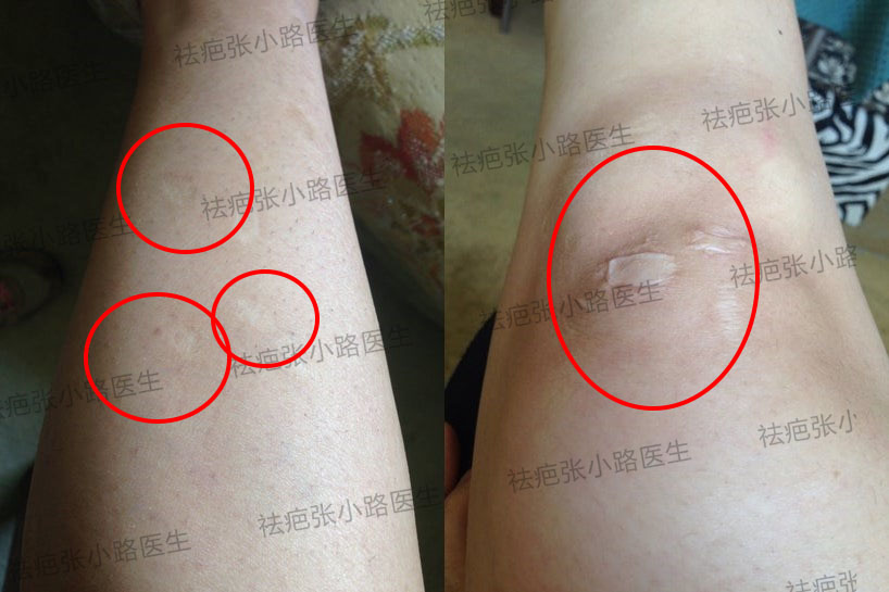 我试过很多除疤膏,但都没有效果,现在我真的想治疗我腿上的伤疤,这样
