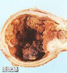 膀胱癌是发生于膀胱黏膜的恶性肿瘤,是泌尿系统最常见的恶性肿瘤之一