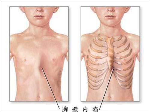 小兒漏斗胸的常見症狀表現