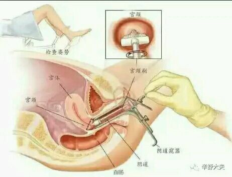 也许她们的子宫可以不被切掉——我们为什么建议您检查hpv?