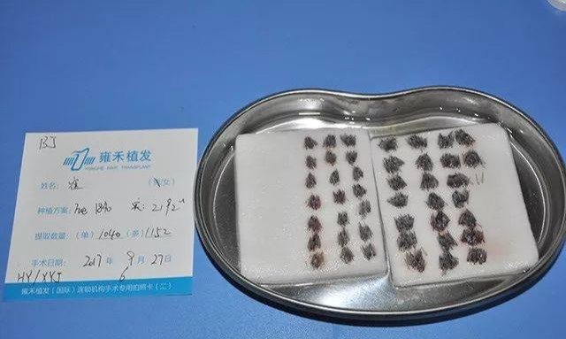 (手术中分离的毛囊.