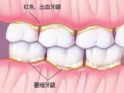 牙龈萎缩可以做牙齿矫正吗