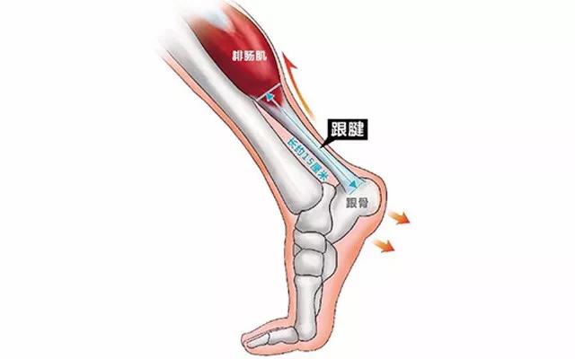 得了跟腱炎怎麼辦呢?多久可以好?