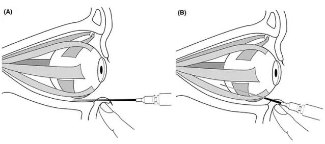透明质酸酶球后注射治疗透明质酸注射引起的眼动脉栓塞是一种比较罕见
