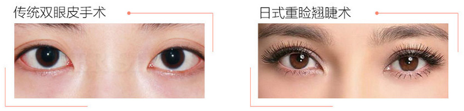 做了双眼皮眼睛就好看了?那可不一定! 做了双眼皮眼睛就好看了?那可不一定!