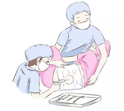 哪些孕妇适合采取无痛分娩?