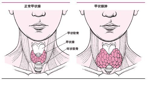 引发甲状腺癌出现的因素?