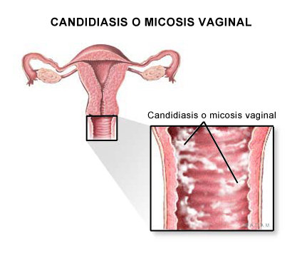 candidiasis-vaginal.png