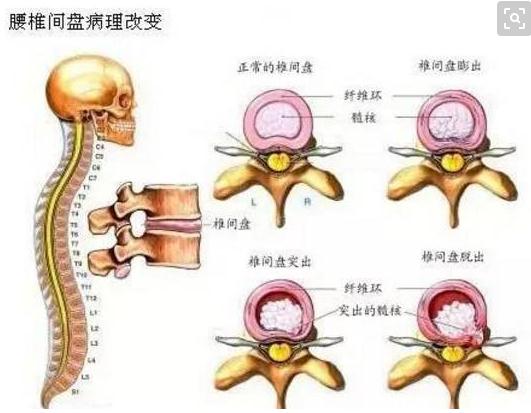 腰痛原因的分类