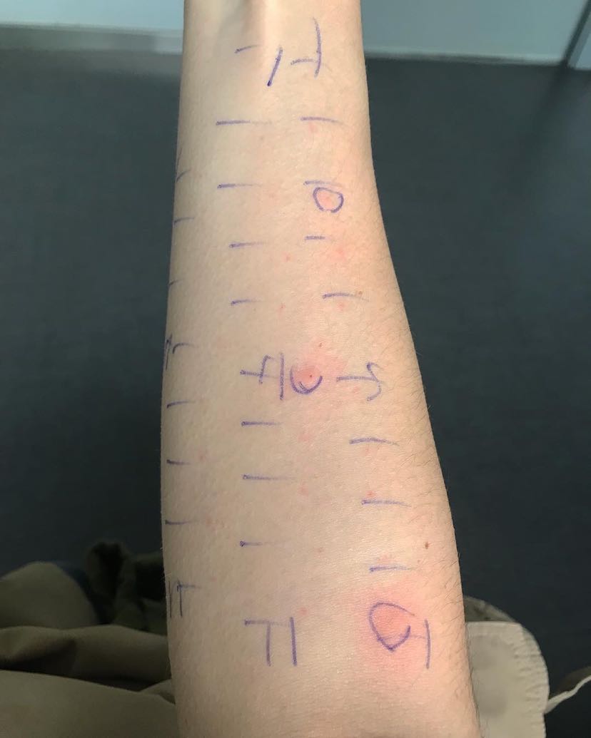 01~002ml (3)斑贴试验:将试剂贴在皮肤上观察72小时后,根据皮肤对