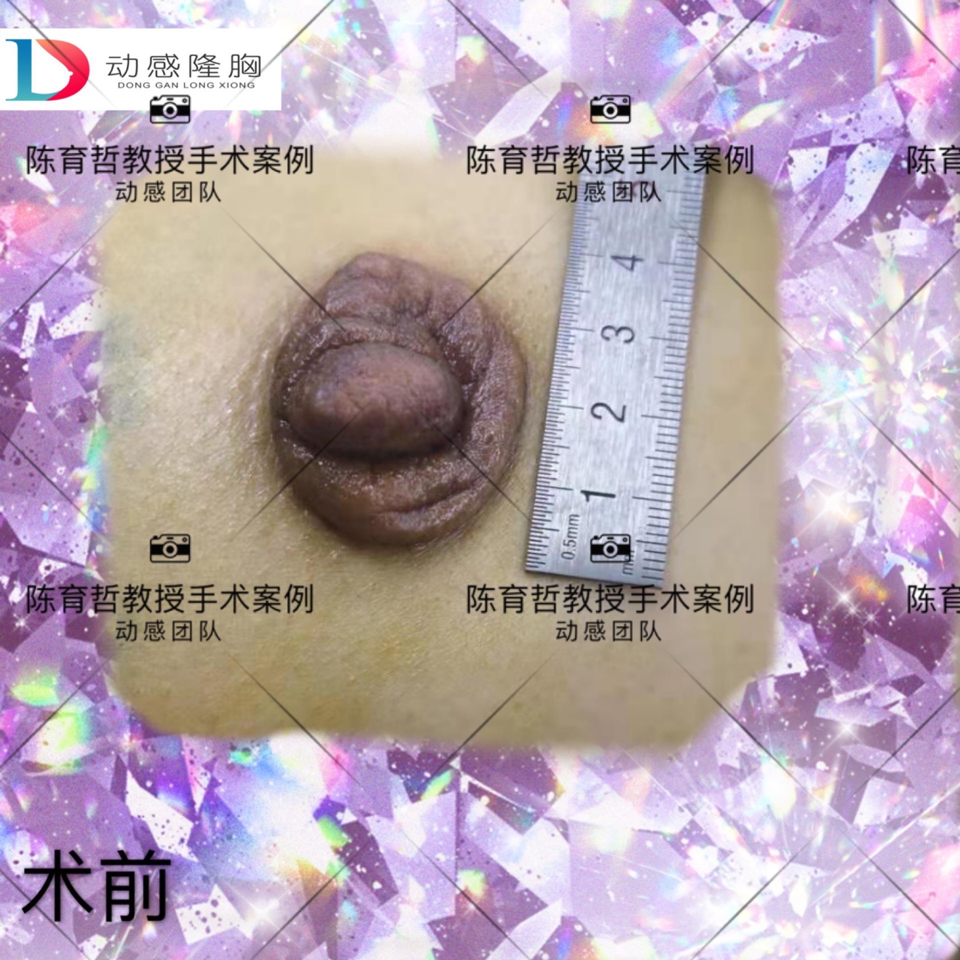 扁平胸治疗图片