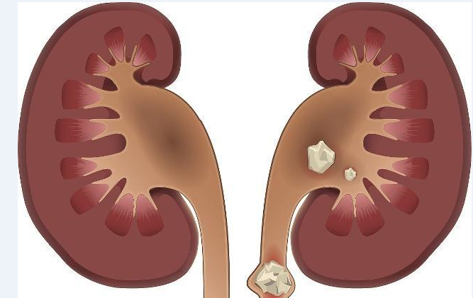 腎結石有什麼危害?光這3個,就不能輕視