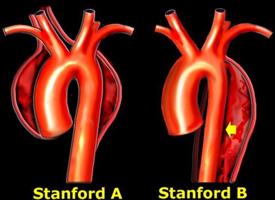 胸痛应警惕—主动脉夹层