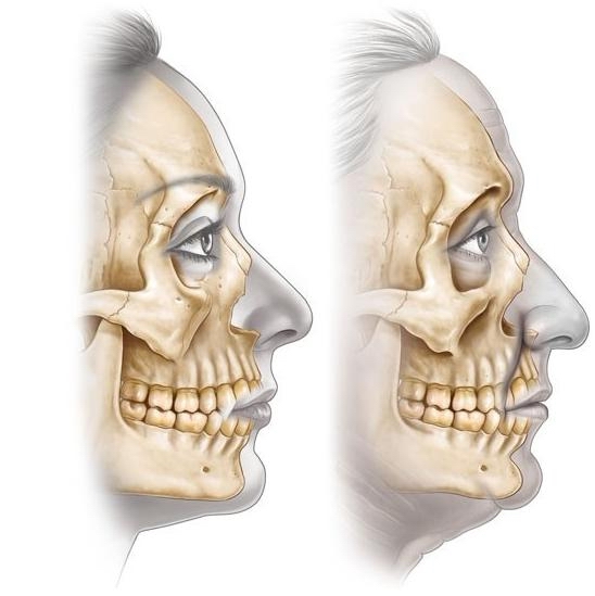 面部骨骼老化解剖的面部年輕化治療應用