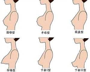 乳房下垂矫正的手术方式有哪些?