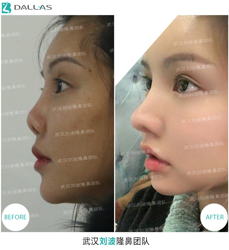 "全肋修复挛缩鼻 皮肤移植 鼻翼缘矫正"真实案例分享