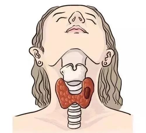 甲状腺结节钙化的含义及早期症状是怎样?钙化离恶变还有多远?