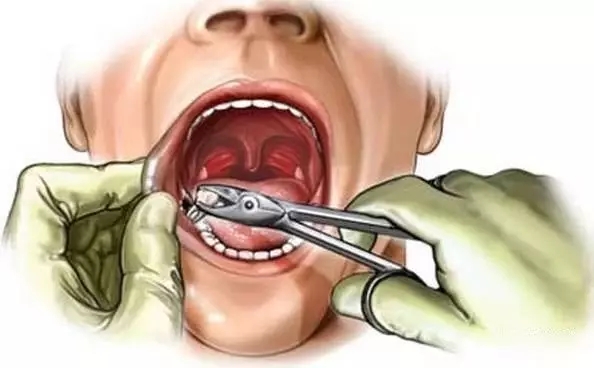 拔牙後回去怎麼護理記住這6點就夠了