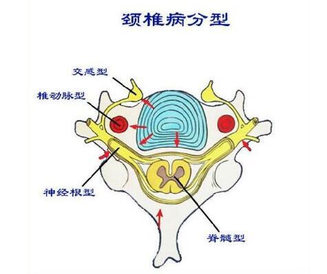 对脊髓型颈椎病认识的五个误区