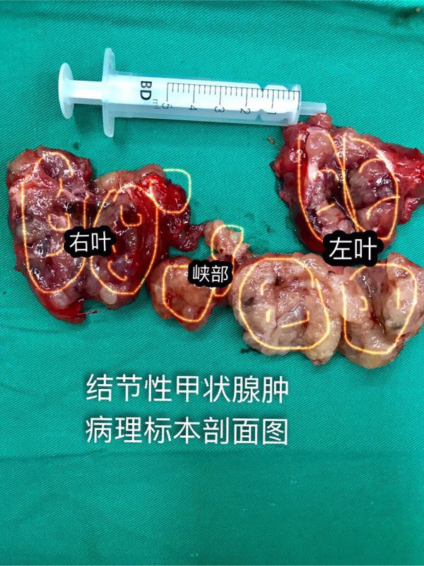 这位结节性甲状腺肿患者为什么要甲状腺全切术后照片回答你