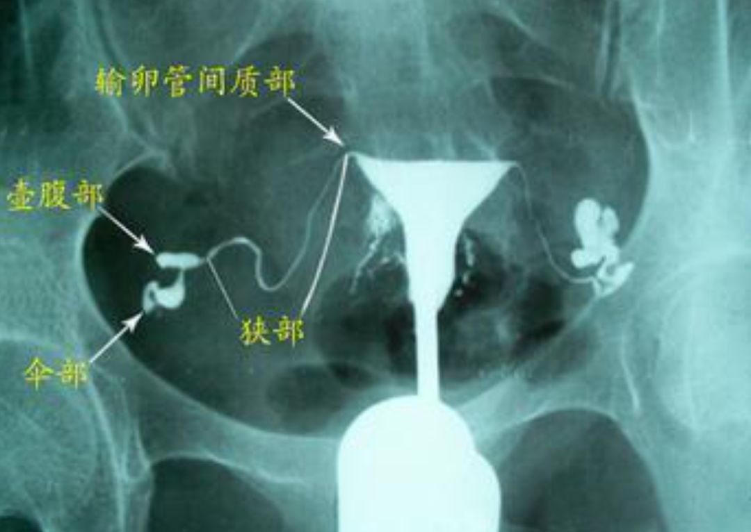 输卵管堵塞易不孕,了解这些离好孕更近一步