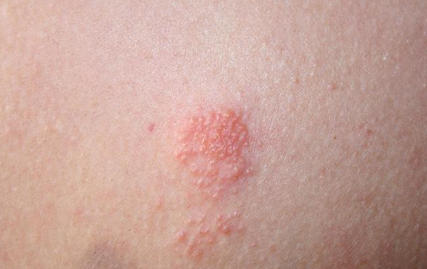 全方位带你认识生殖器疱疹