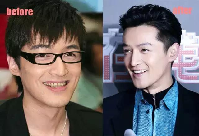 孙杨等众多明星都在做的隐形牙套,究竟是什么?