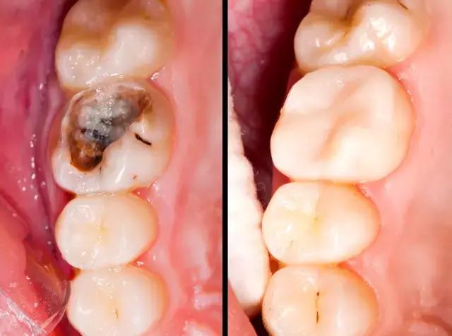 牙髓坏死蛀牙图片