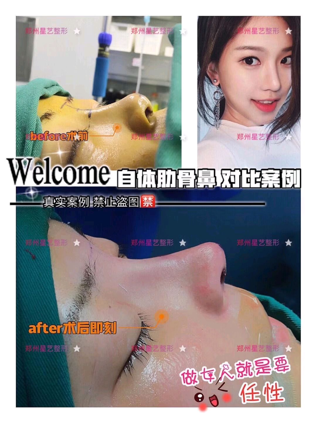 肋骨隆鼻术前术后