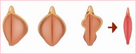 【小阴唇全解】(十二)处女做小阴唇缩小术,会有影响吗?