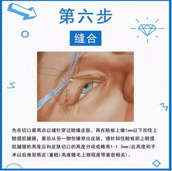 图解全切双眼皮全过程,一秒钟读懂双眼皮手术