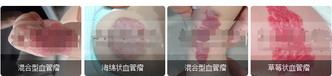 上海胎记医院：跟有血管瘤的人接触会不会传染?