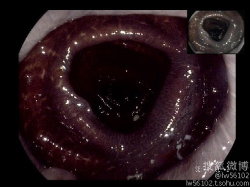 一张是正常结肠的图片,可谓红润有光泽,另一张是结肠黑变病患者的图片