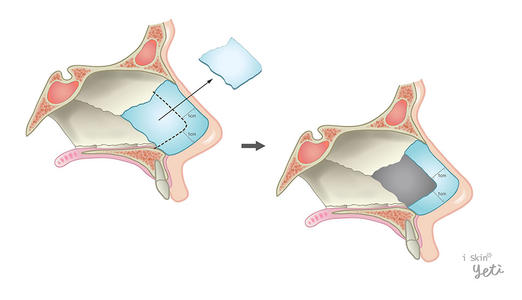 师:应力改变有可能导致鼻中隔偏曲的加重,加重呼吸功能障碍.