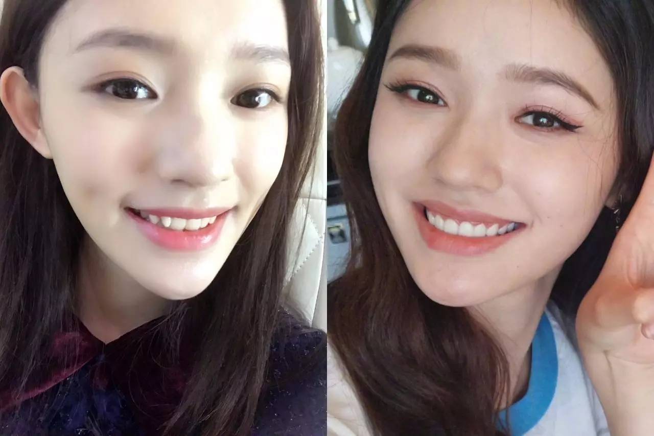 问题2:牙齿不齐,肤白貌美也不敢张嘴笑!