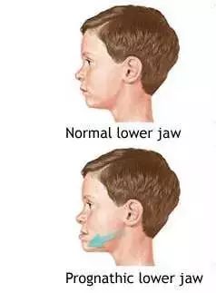 【错颌畸形系列】"地包天"的最佳治疗时间