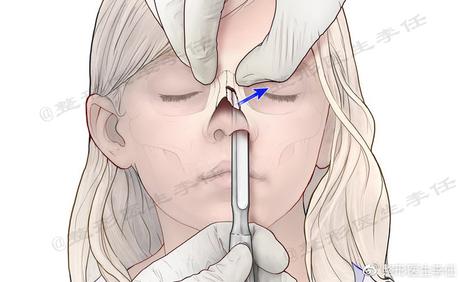 闭合方式急性期矫正外伤性歪鼻/鼻骨骨折.(图片来源于ao foundation)