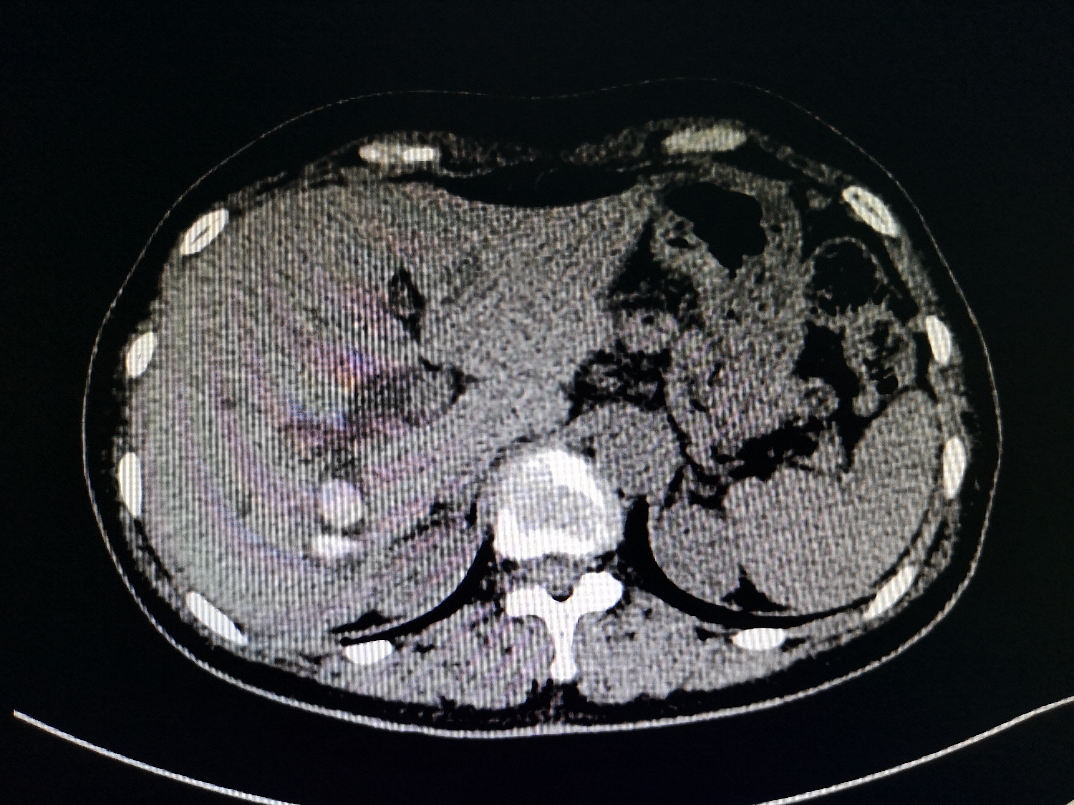 肝右叶胆管结石图片