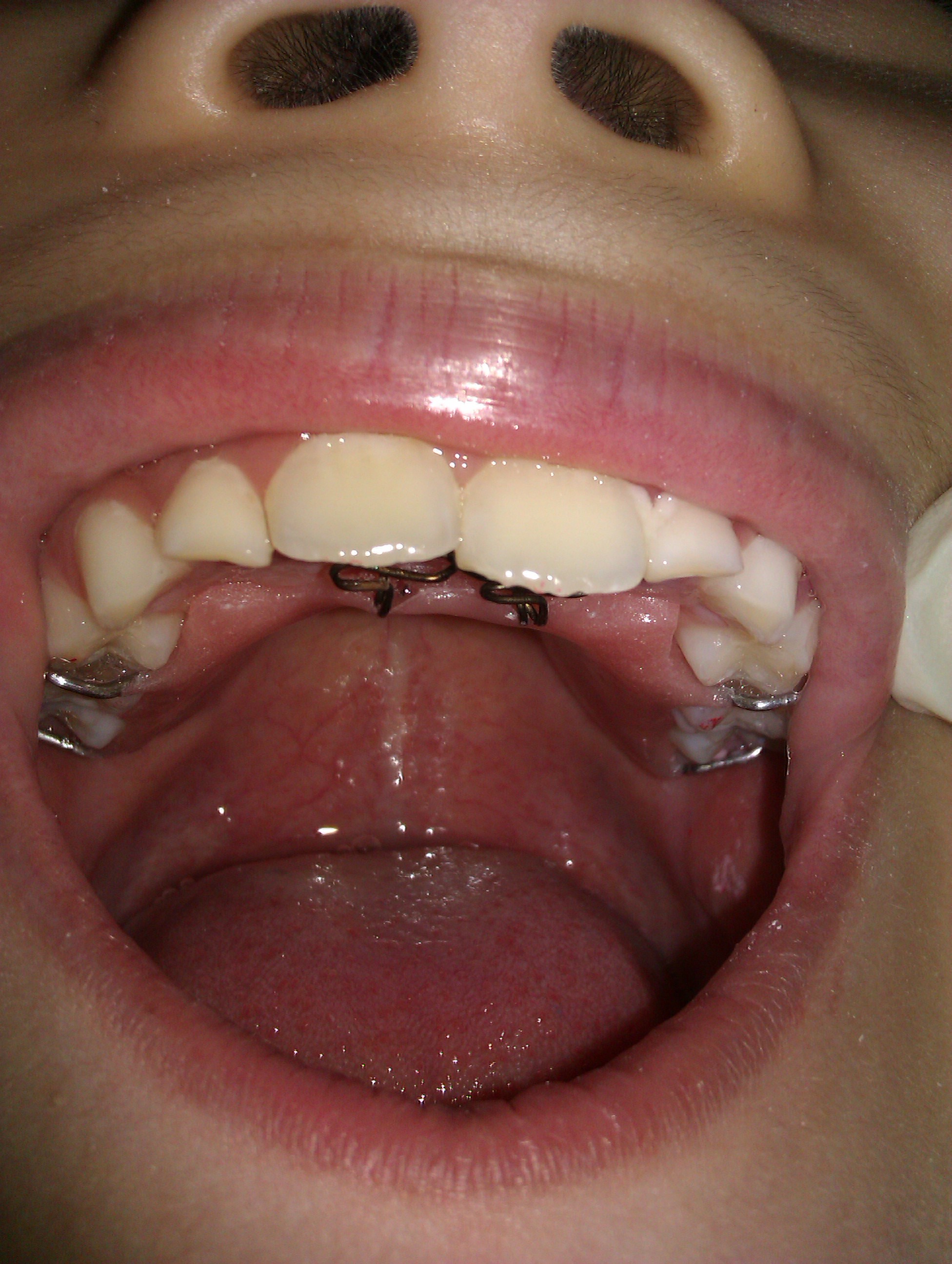 针对家长在乳牙及替牙期不重视,以为换牙后牙齿会变整齐正常的误区!