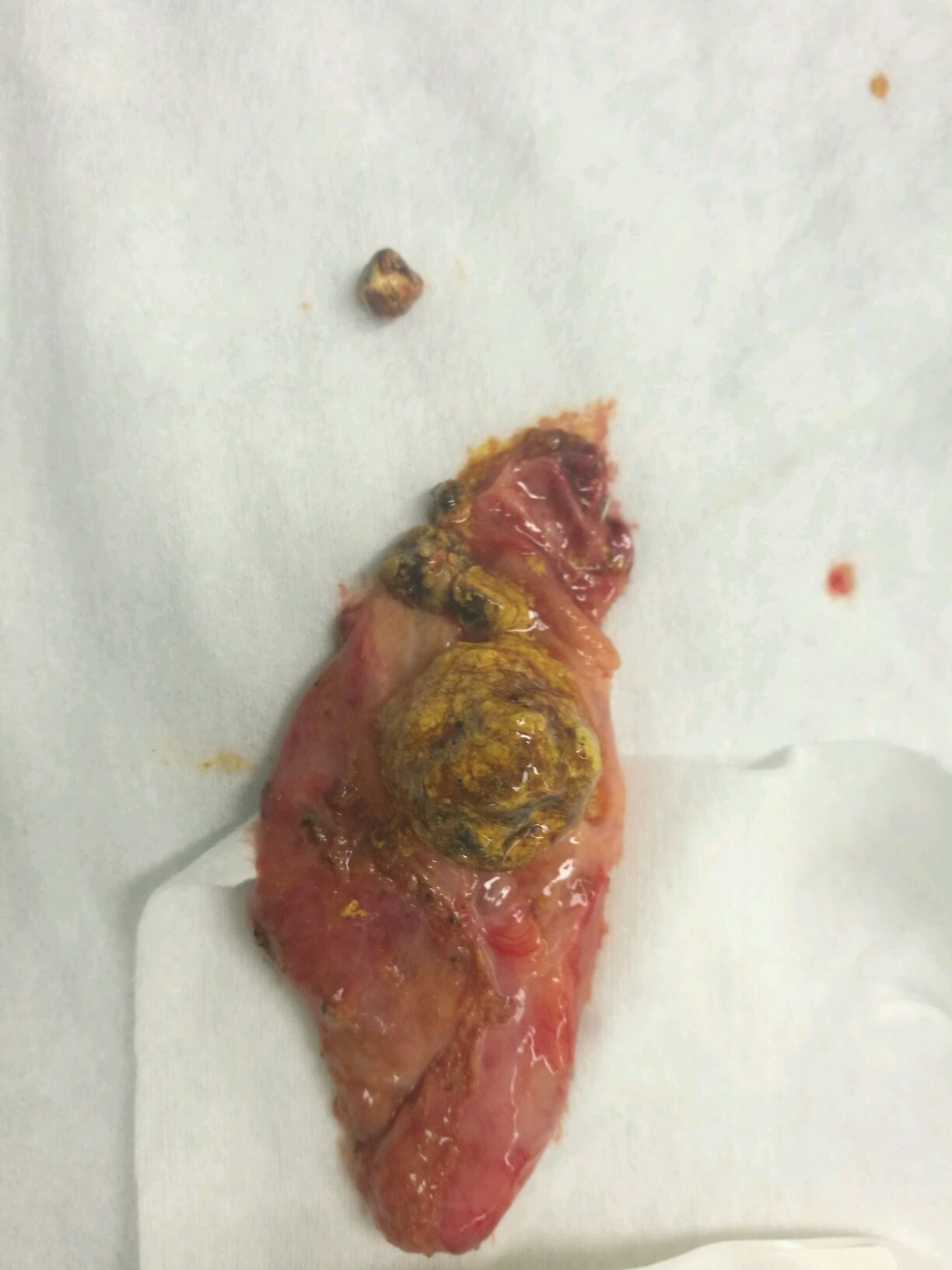 不能缓解,诊断为胆囊充满型结石伴急性胆囊炎,同时合并胆总管下段多发