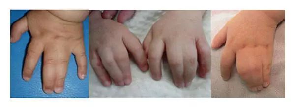6根手指,手指相连,拇趾外翻……手足畸形怎么治?