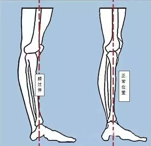 什么是膝反张如何进行家庭康复