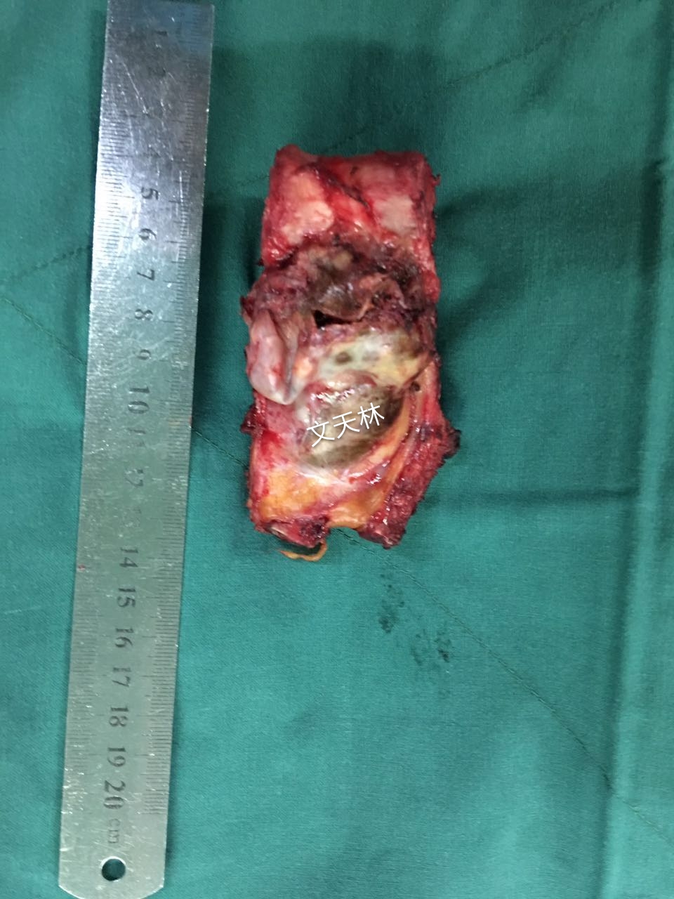 原发性胸椎恶性肿瘤